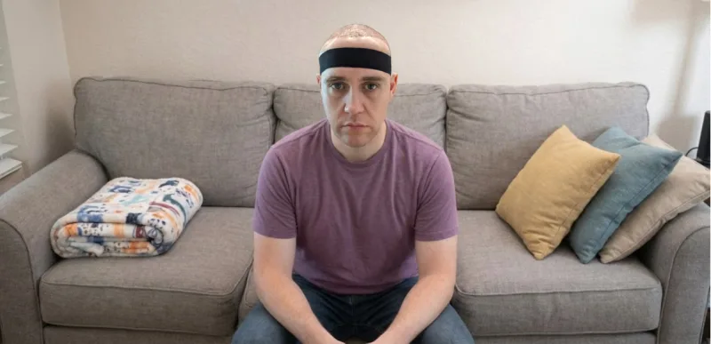 My Hair Transplant & Running I: How Fixing One Thing Stopped Everything Else